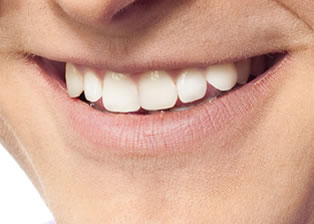 Dentures / Partials