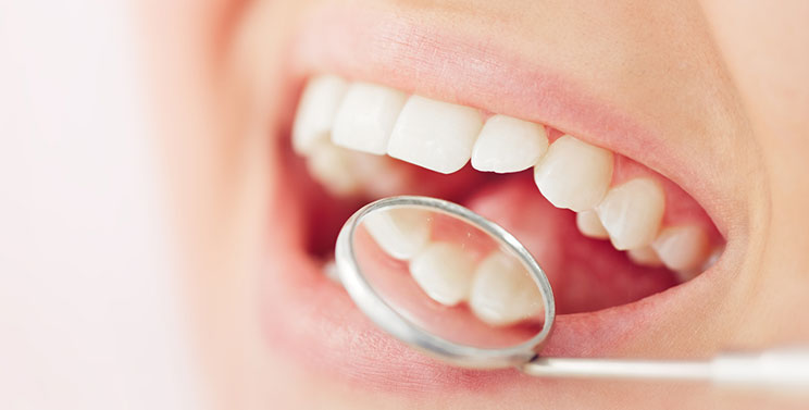 TOOTH COLORED FILLINGS