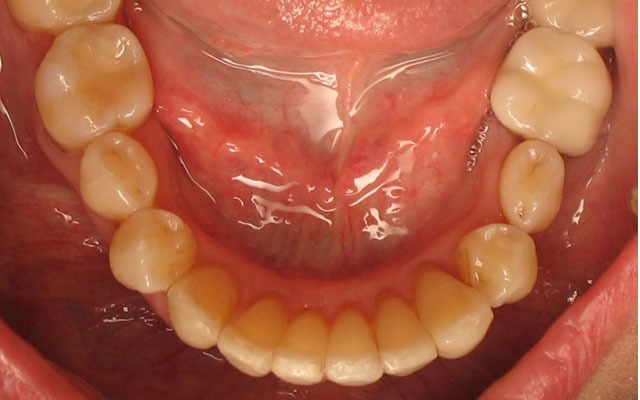 Invisalign after photo — straightened smile — Westlake Smile Design, Westlake Village CA