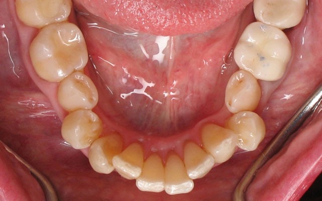 Invisalign before photo — crowded lower teeth — Westlake Village patient