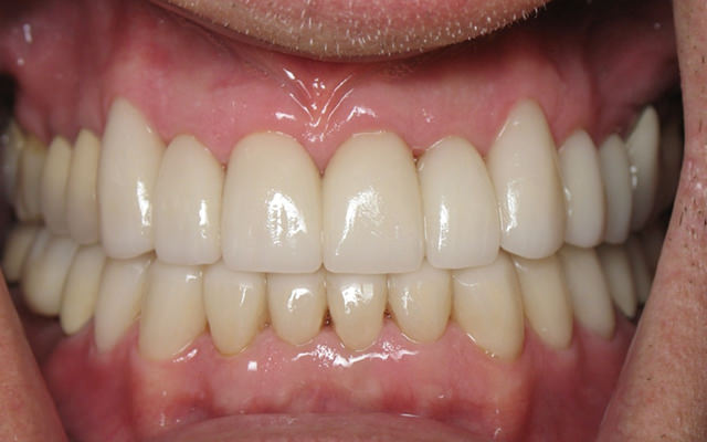 After photo: Invisalign followed by porcelain veneers