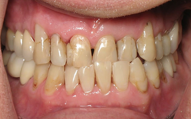 Before photo: Invisalign followed by porcelain veneers