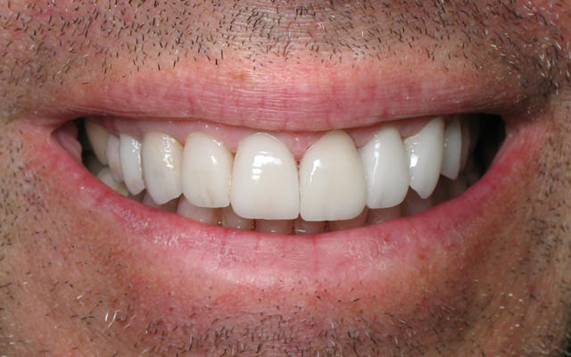 After photo: Porcelain veneers