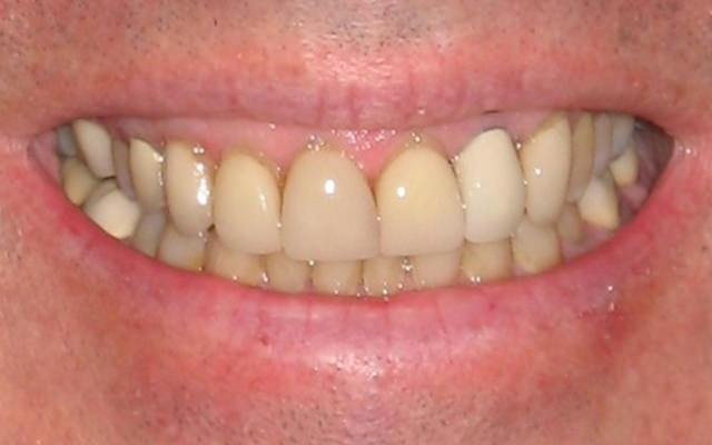 Before photo: Porcelain veneers