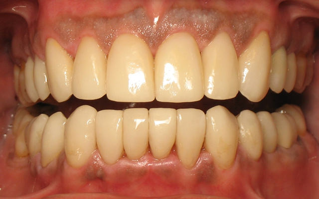 After photo: Invisalign followed by porcelain veneers