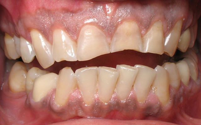 Before photo: Invisalign followed by porcelain veneers