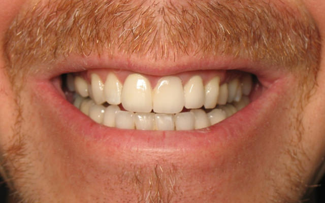 After photo: Porcelain crowns and veneers