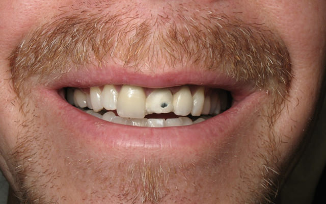 Before photo: Porcelain crowns and veneers
