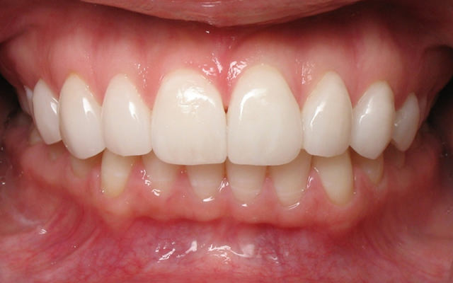 After photo: Porcelain veneers