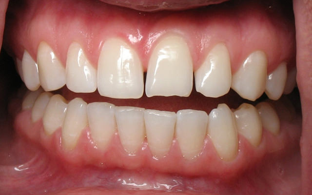Before photo: Porcelain veneers