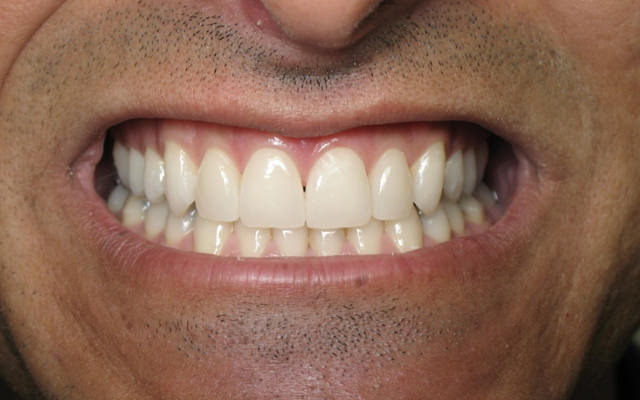 After photo: Porcelain veneers