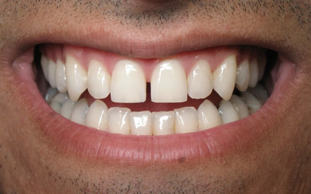 Before photo: Porcelain veneers