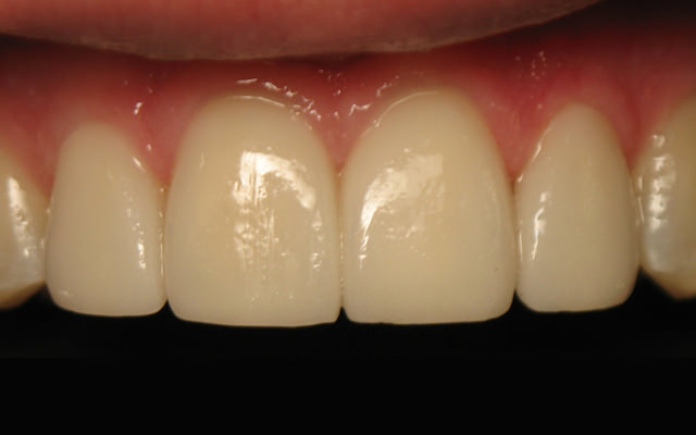 After photo: Porcelain veneers