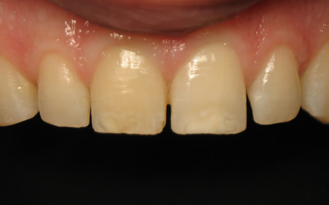 Before photo: Porcelain veneers