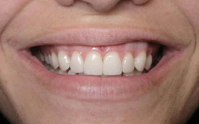 After photo: Porcelain veneers