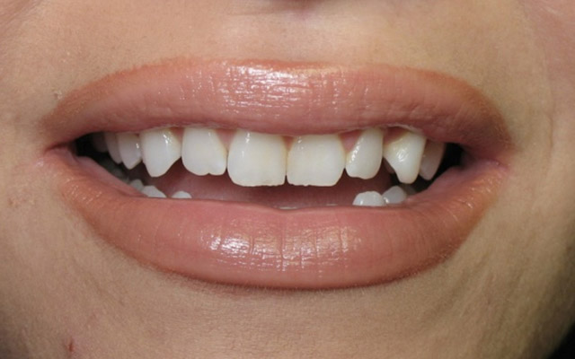 Before photo: Porcelain veneers
