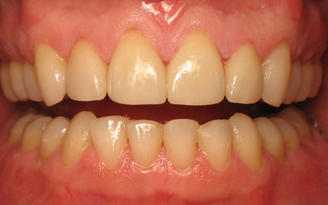 After photo: Porcelain veneers