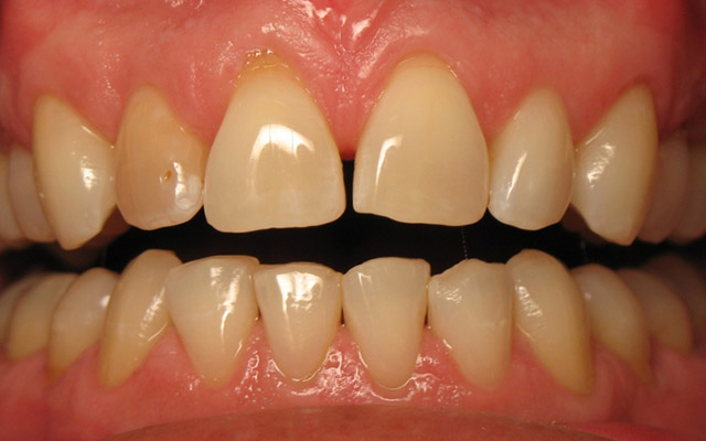 Before photo: Porcelain veneers