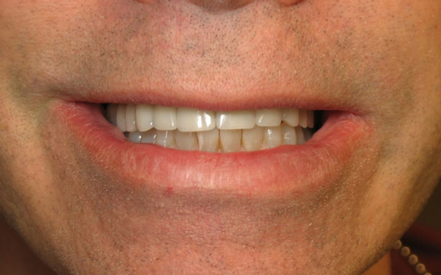 After photo: Porcelain veneers