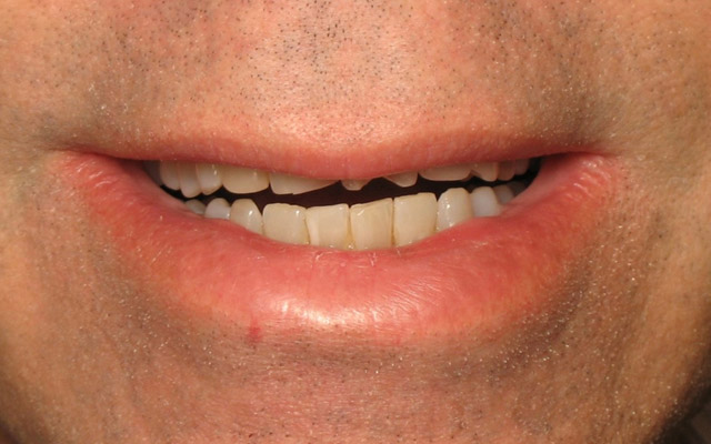 Before photo: Porcelain veneers