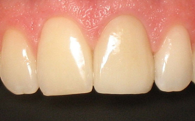 After photo: Porcelain crown and veneer