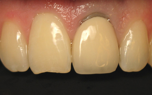 Before photo: Porcelain crown and veneer