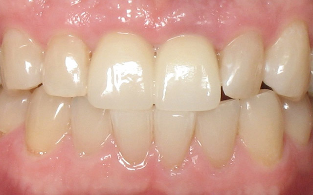 After photo: Dental Implant
