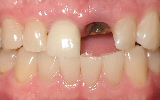 Before photo: Dental Implant