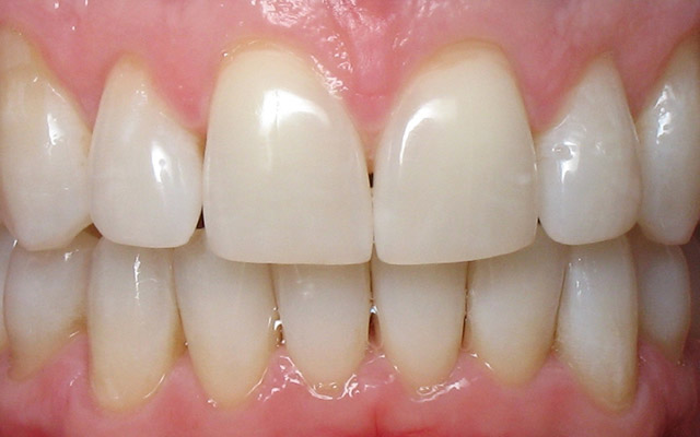 After photo: Porcelain crowns and veneers