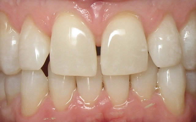Before photo: Porcelain crowns and veneers