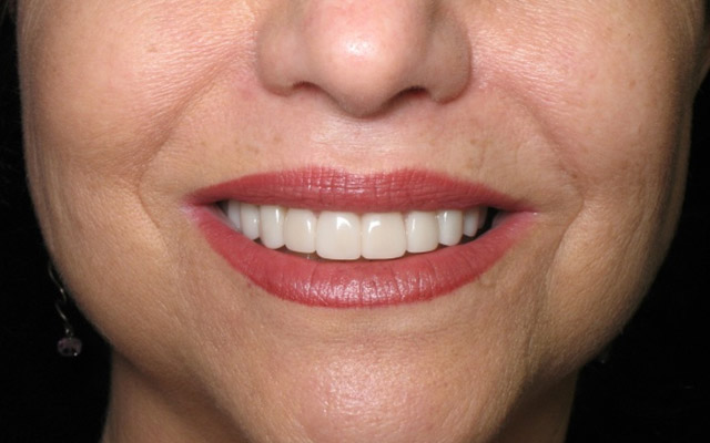 After photo: Porcelain veneers