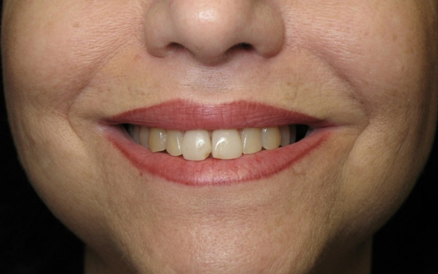 Before photo: Porcelain veneers