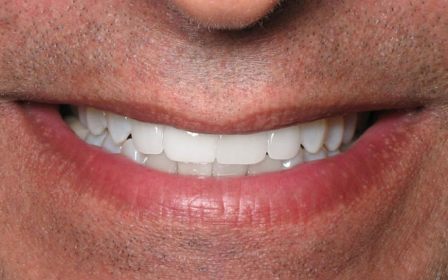 After photo: Invisalign followed by porcelain veneers