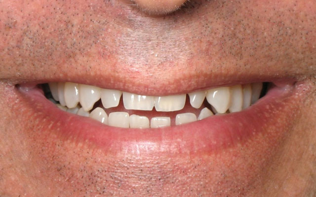 Before photo: Invisalign followed by porcelain veneers