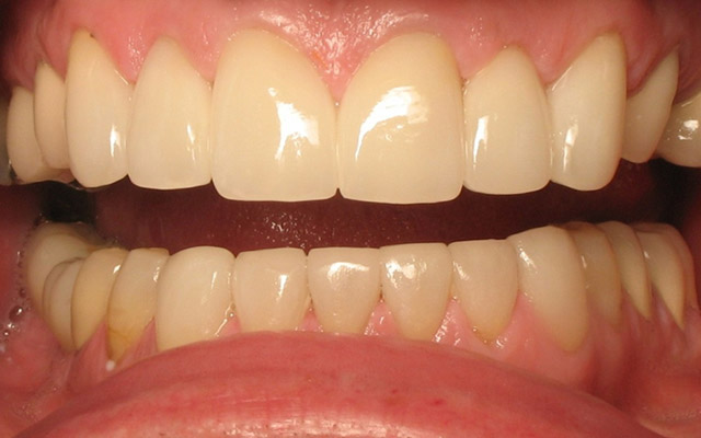 After photo: Porcelain veneers