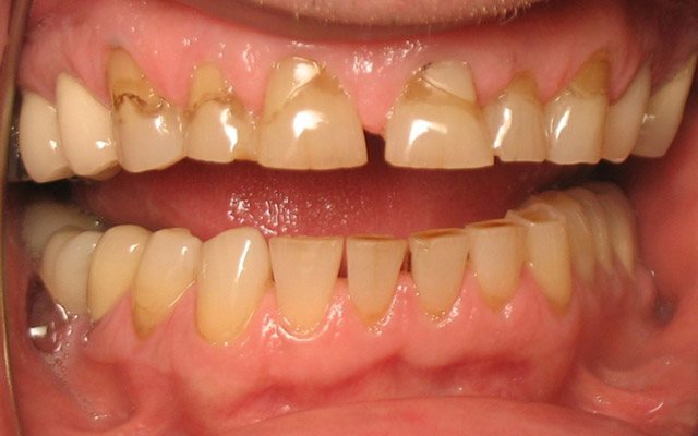 Before photo: Porcelain veneers