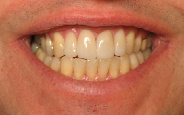 After photo: Invisalign and Porcelain Veneers