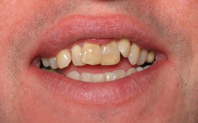 Before photo: Invisalign and Porcelain Veneers