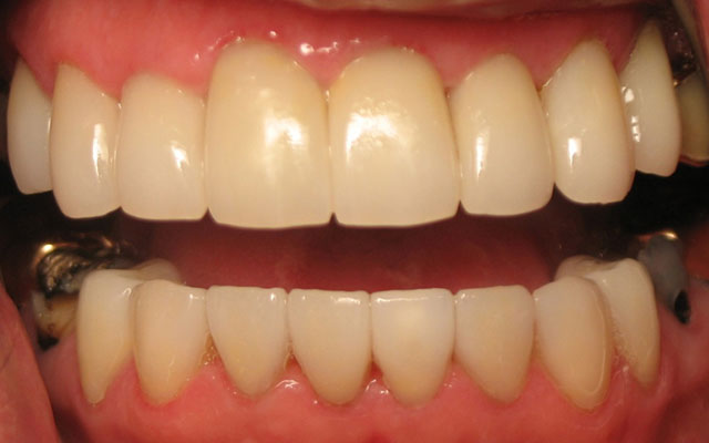 After photo: Porcelain crowns and porcelain veneers