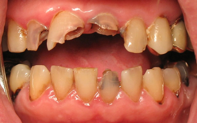 Before photo: Porcelain crowns and porcelain veneers