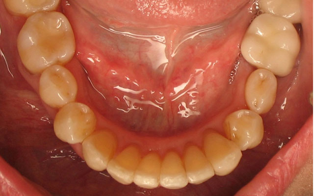 After photo: Invisalign