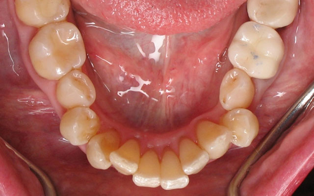 Before photo: Invisalign