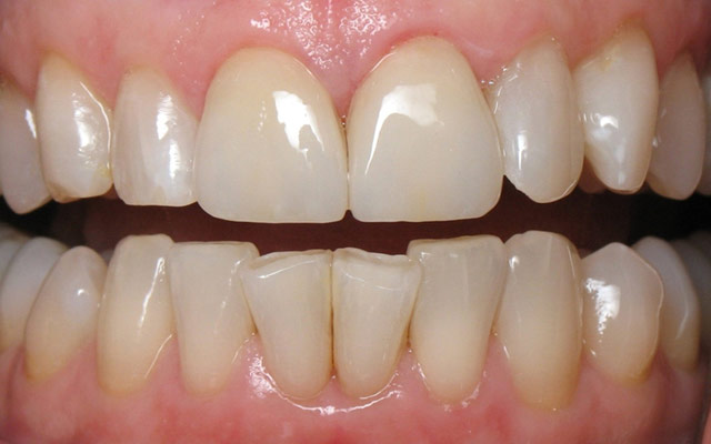 After photo: Porcelain veneers