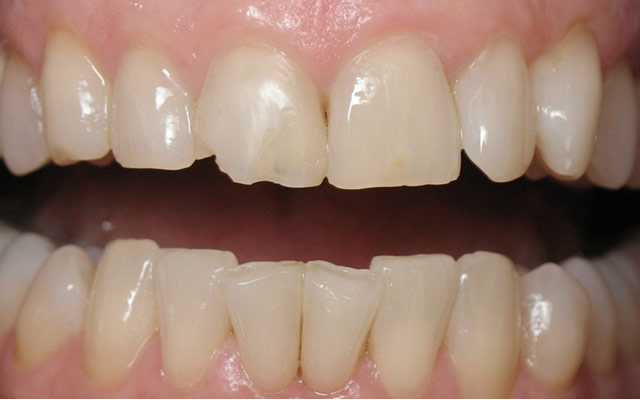 Before photo: Porcelain veneers