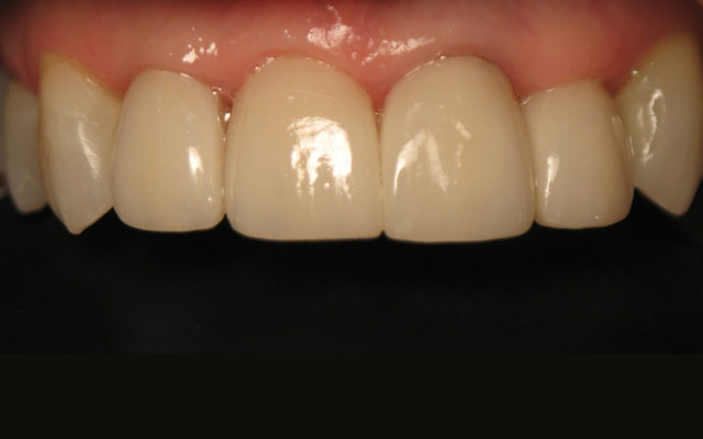 After photo: Porcelain veneers
