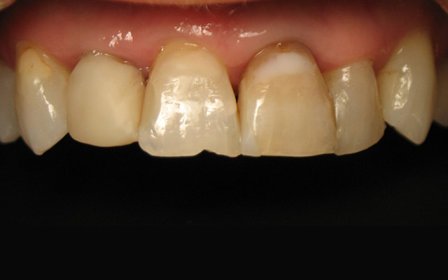 Before photo: Porcelain veneers