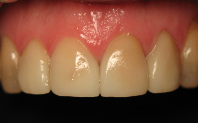 After photo: Porcelain veneers