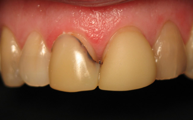 Before photo: Porcelain veneers