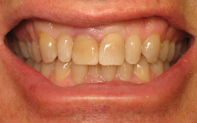 After photo: Porcelain veneers