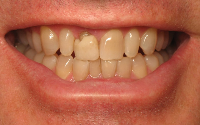Before photo: Porcelain veneers